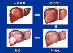 肝纖維化