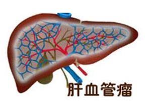 肝血管瘤